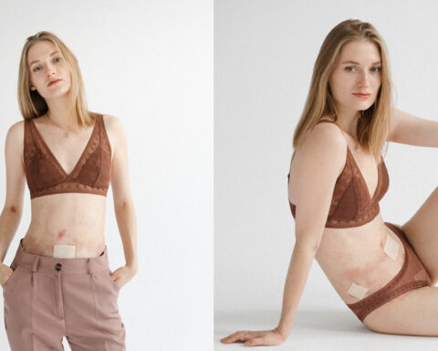 Бульозний епідермоліз або «синдром метелика»