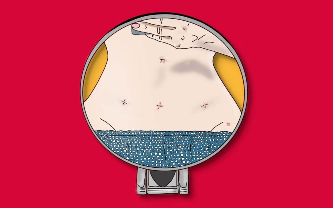 Всі статті 16 Як я видалила матку