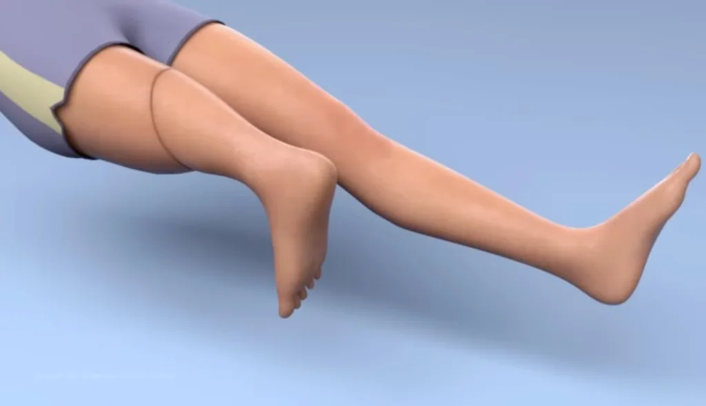 У Львові провели унікальну операцію: дівчині видалили середню частину ноги, а нижню пришили задом наперед