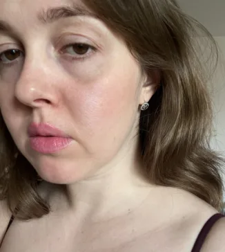 «Раніше не могла вийти на вулицю без макіяжу»: Три історії про акне від жінок 