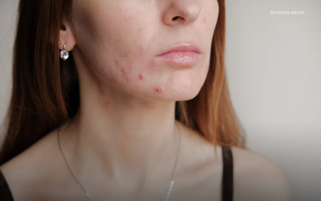 «Раніше не могла вийти на вулицю без макіяжу»: Три історії про акне від жінок 