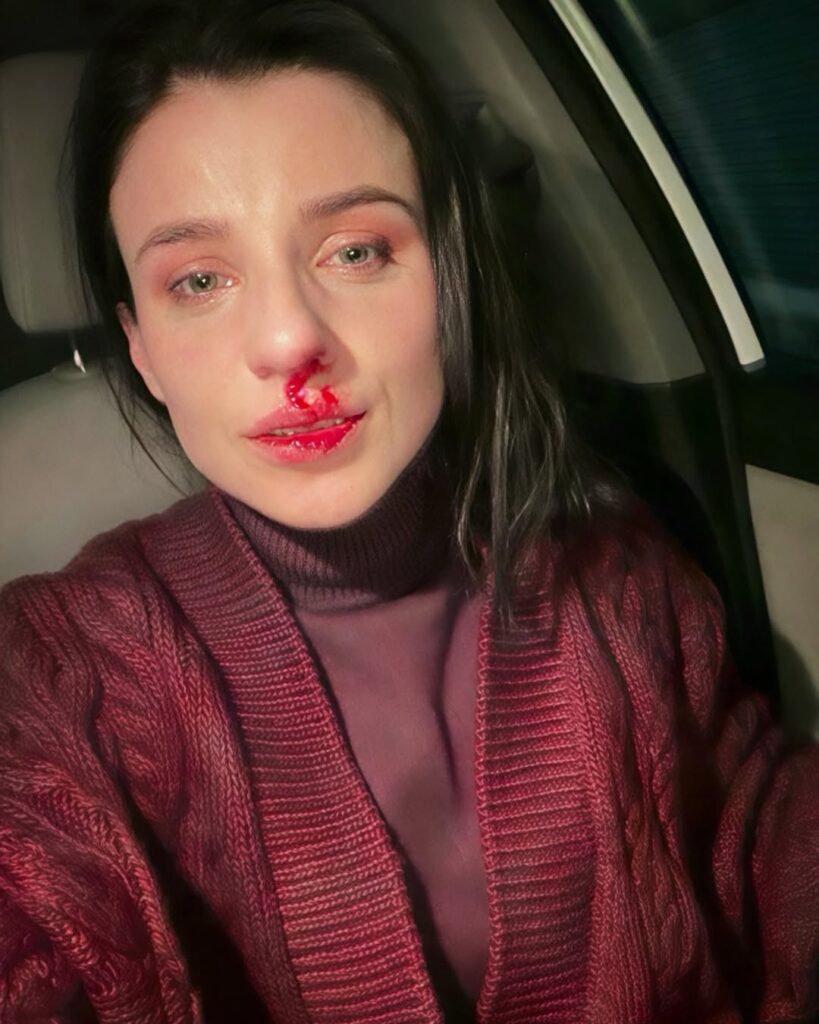 «Бив ногами в живіт та душив»: мешканка Київщини заявила про напад колишнього чоловіка та ігнорування справи поліцією. Оновлено